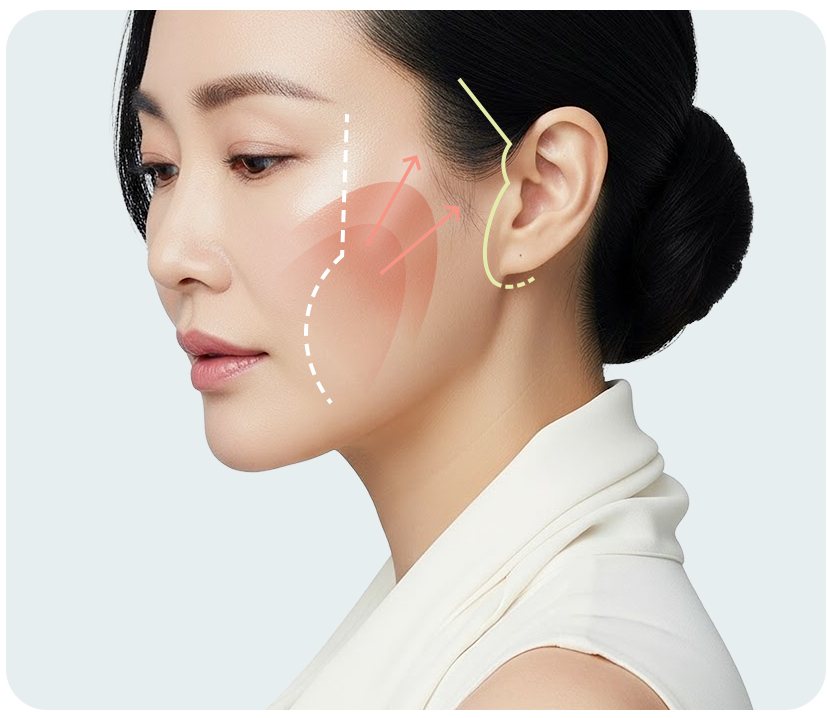 옆모습 여성 모델, 귀 앞 절개선과 당기는 방향 표시