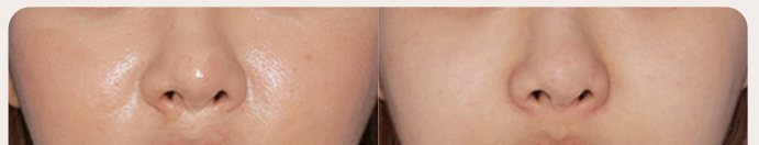 팔자 위 지방흡입 전후 1 — 왼쪽 Before / 오른쪽 After 1 month