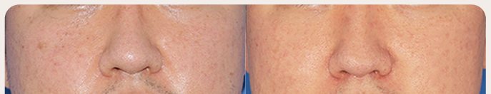 팔자 위 지방흡입 전후 2 — 왼쪽 Before / 오른쪽 After 1 month