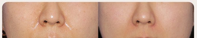 팔자 위 지방흡입 전후 3 — 왼쪽 Before / 오른쪽 After 1 month