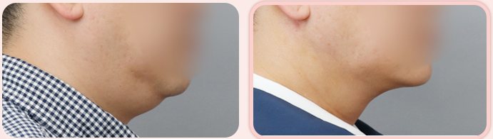 이중턱 흡묶고 BEFORE / AFTER 3M 옆얼굴 전후 (왼쪽 열 1번째 줄)
