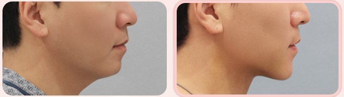 이중턱 흡묶고 BEFORE / AFTER 3M 옆얼굴 전후 (오른쪽 열 1번째 줄)