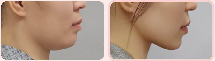 이중턱 흡묶고 BEFORE / AFTER 3M 옆얼굴 전후 (왼쪽 열 2번째 줄)