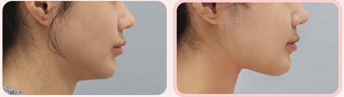 이중턱 흡묶고 BEFORE / AFTER 3M 옆얼굴 전후 (오른쪽 열 2번째 줄)