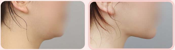 이중턱 흡묶고 BEFORE / AFTER 3M 옆얼굴 전후 (왼쪽 열 3번째 줄)