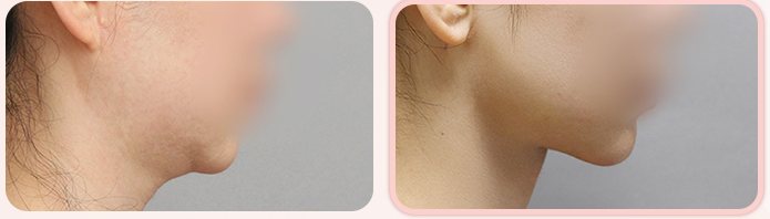 이중턱 흡묶고 BEFORE / AFTER 3M 옆얼굴 전후 (오른쪽 열 3번째 줄)