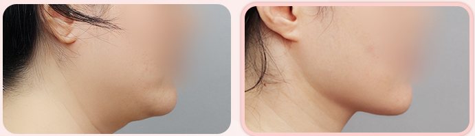 이중턱 흡묶고 BEFORE / AFTER 3M 옆얼굴 전후 (왼쪽 열 4번째 줄)