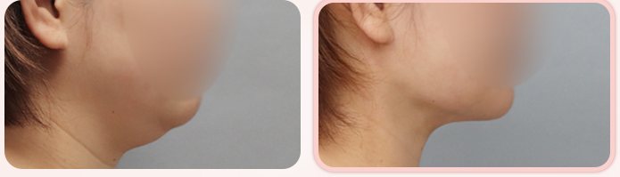이중턱 흡묶고 BEFORE / AFTER 3M 옆얼굴 전후 (오른쪽 열 4번째 줄)