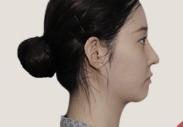 일반 이중턱성형(타 병원 수술 후) 옆얼굴