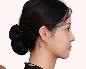신상 이중턱 흡묶고 재수술 후 옆얼굴