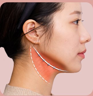STEP 03 귀 밑 고정 — 해먹 형태 고정선 표시