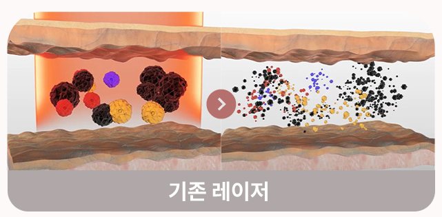 기존 레이저의 색소 분해 도식