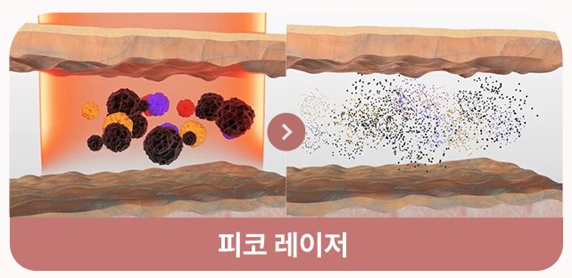 피코 레이저의 미세 색소 분해 도식