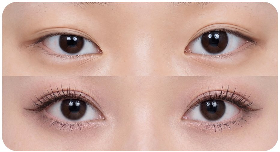 CASE 02 쌍꺼풀 라인이 풀린 경우 — 위·아래 눈 비교