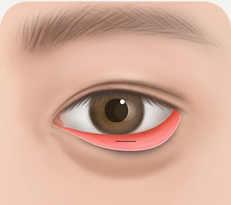 눈밑지방재배치 STEP 02 — 결막 절개