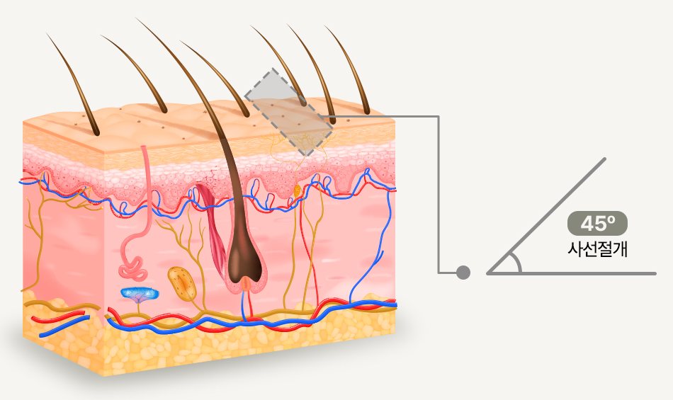 두피 단면 도식 — 모낭 방향을 따라 45° 사선절개