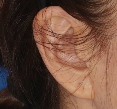 귀 앞 절개 부위 수술전