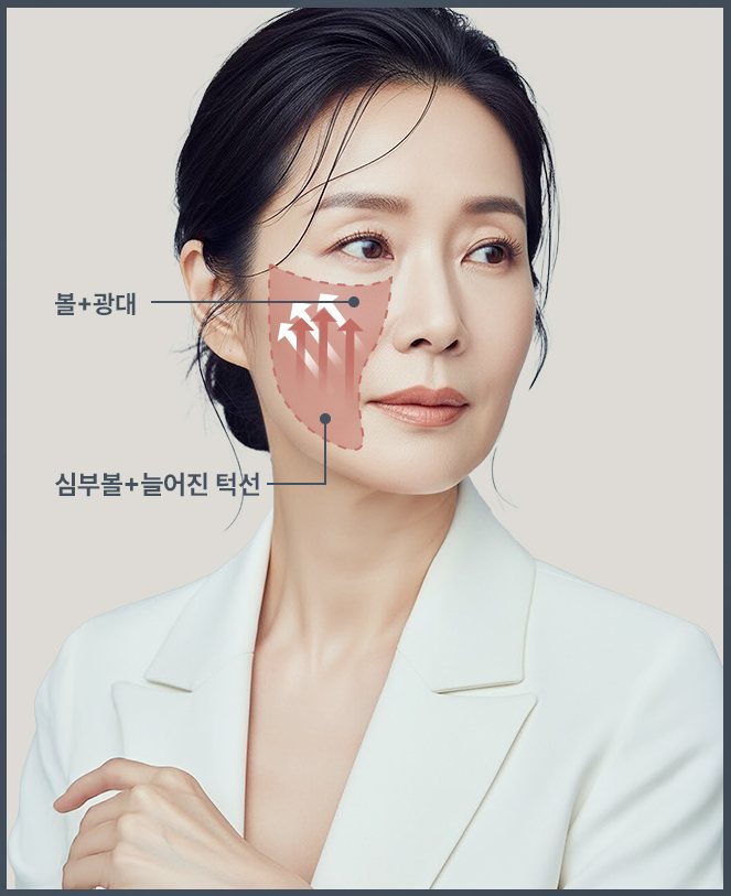볼+광대, 심부볼+늘어진 턱선 부위를 표시한 모델 얼굴