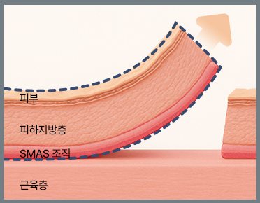 딥플레인 박리 층 도식(피부·피하지방층·SMAS 조직·근육층)