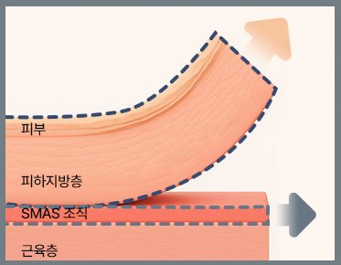 듀얼플레인 박리 층 도식