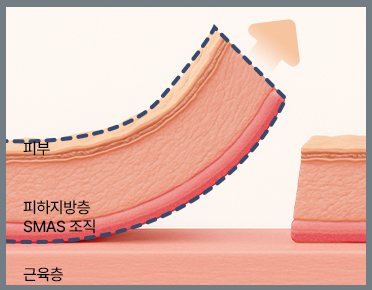 확장형 딥플레인 박리 층 도식