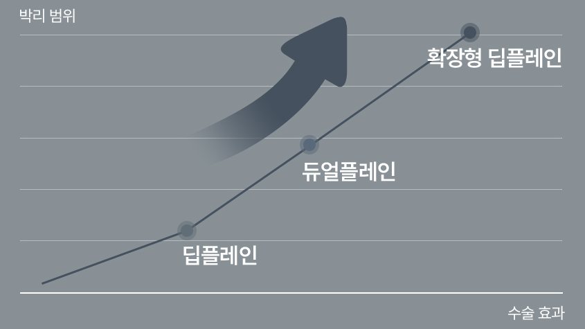 박리 범위와 수술 효과 그래프(딥플레인·듀얼플레인·확장형 딥플레인)