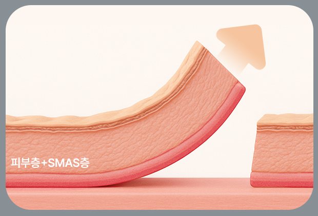 딥플레인 도식(피부층+SMAS층 함께 당김)