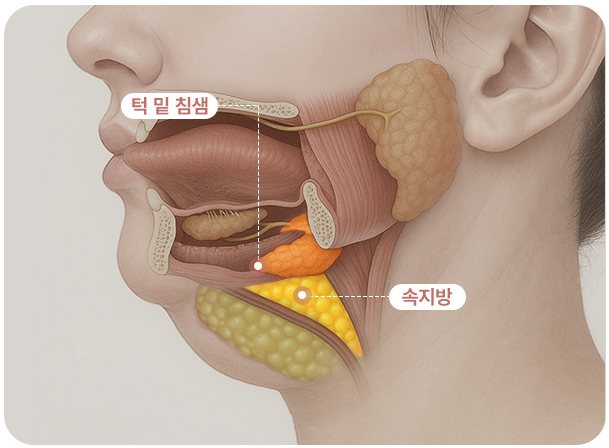두꺼비목성형 2단계 하관 구조 일러스트(턱 밑 침샘·속지방)