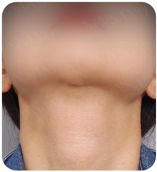 목 절개 흉터 2개월차