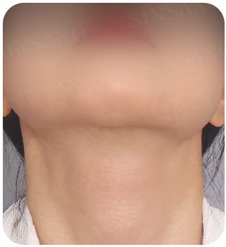 목 절개 흉터 3개월차