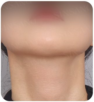 목 절개 흉터 6개월차
