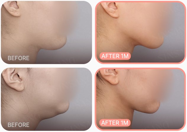 두꺼비목성형 2단계 전후(BEFORE / AFTER 1M, 두 각도)