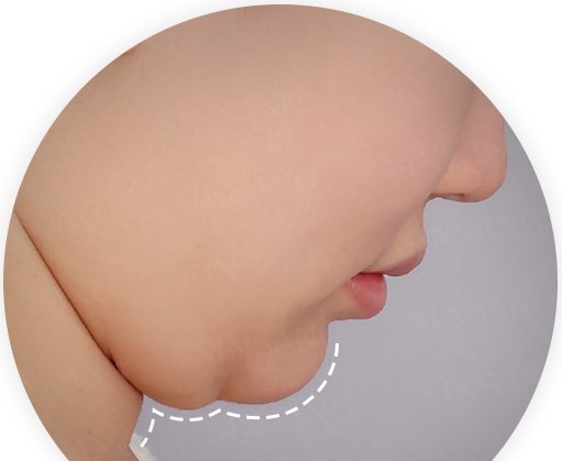 두꺼비목성형 BEFORE 옆모습(턱선 점선 표시)
