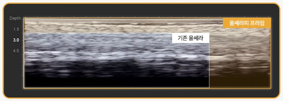 기존 울쎄라와 울쎄라피 프라임 초음파 영상 깊이 비교